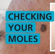 Moles Moles are small, coloured spots on the skin. Most people have them and they're usually nothing to worry about unless they change size, shape or colour.